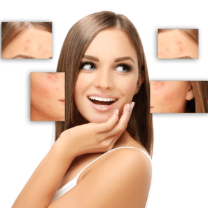 טיפול פוסט אקנה \ צלקות