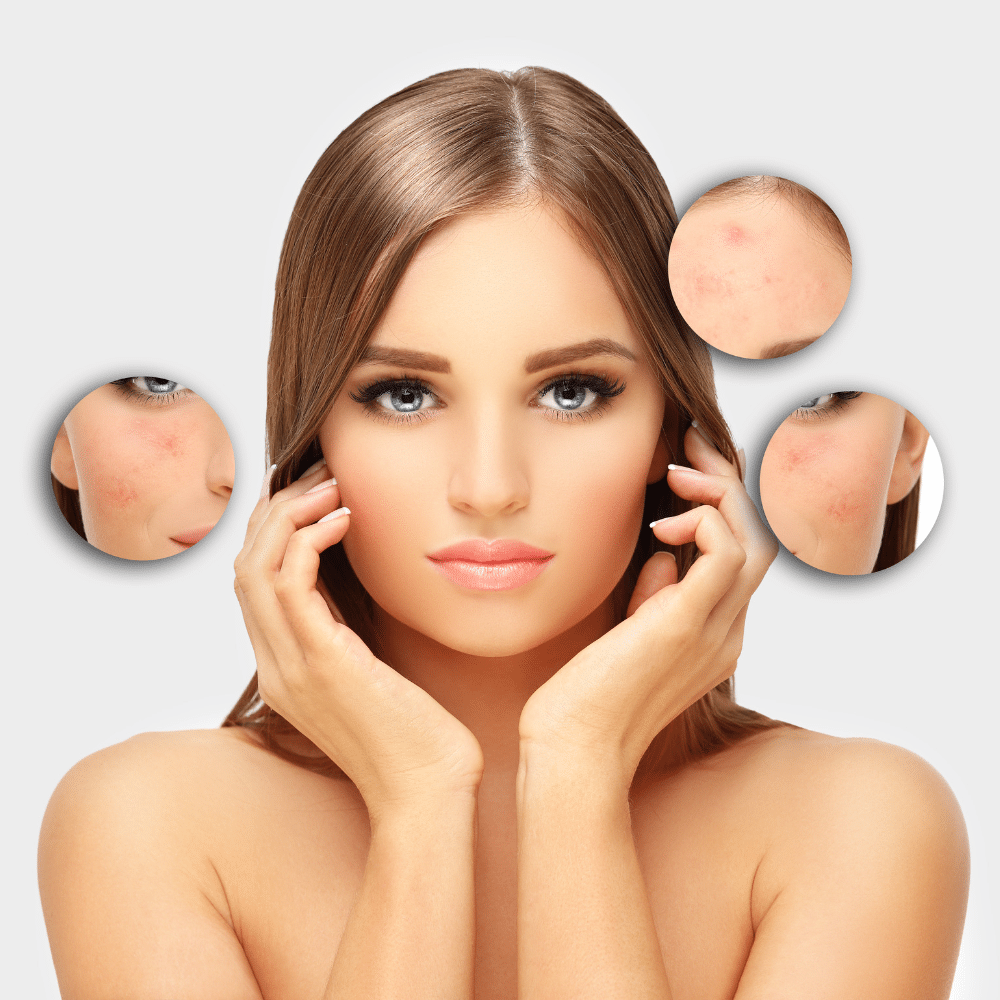 טיפול אקנה – הורמונלי \ גיל הנעורים